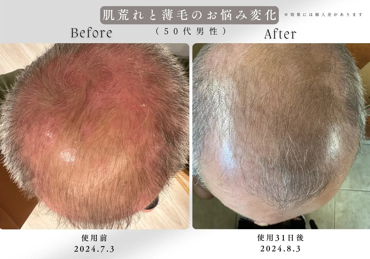 溶け込むことのできる極限域の濃度を記録した高濃度炭酸泉メーカーEVOKESODAご愛用者様から薄毛の悩みや頭皮環境の改善を感じるという声をいただきました。