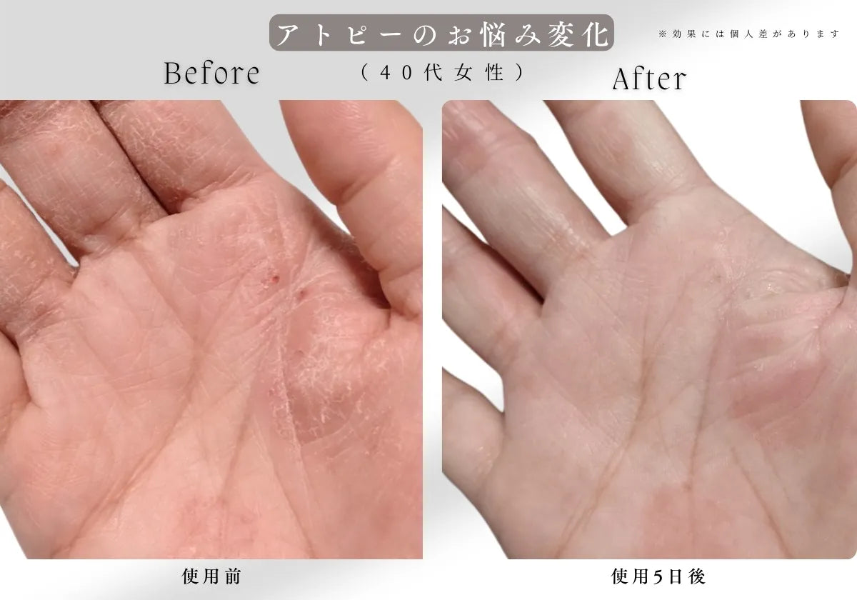 業界最高レベルのの高濃度を記録した高濃度炭酸泉メーカーEVOKESODAご愛用者様からアトピー性皮膚炎の改善を感じるという声をいただきました。